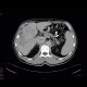 Cholangiocellular carcinoma: CT - Computed tomography